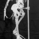 Harry Eastlack FOP-Skelett